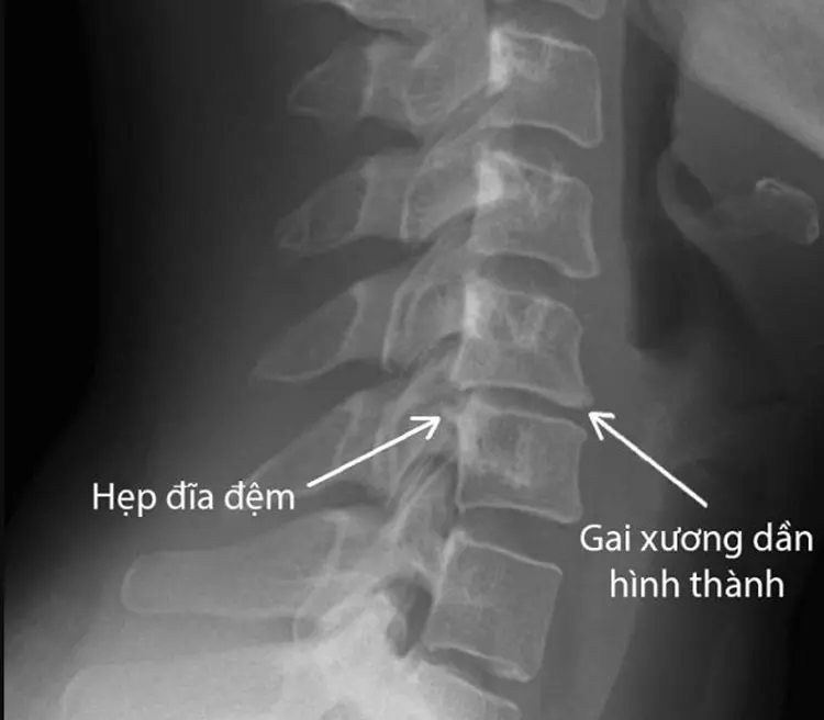 Đau vai gáy, tê bì tay là dấu hiệu nhận biết thoái hóa đốt sống cổ